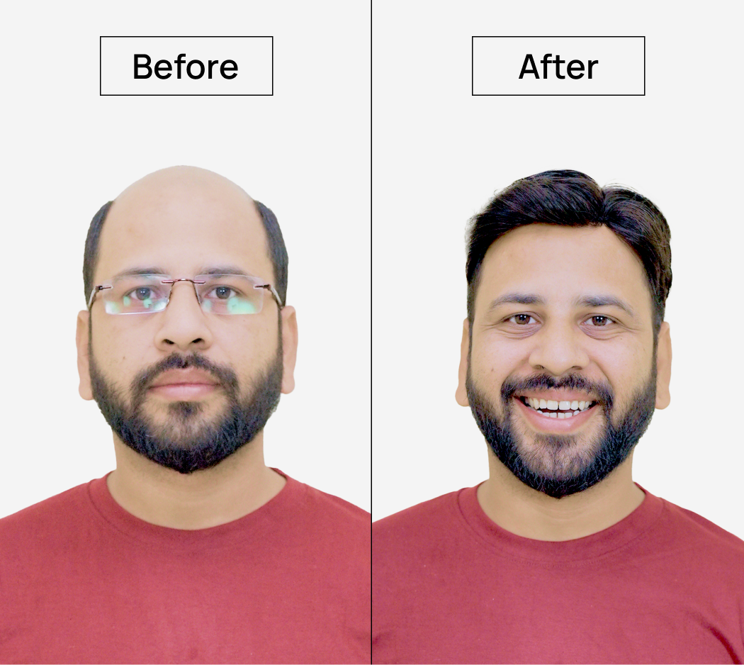 Polyfuse Hair System: An Ultra-Thin, Lightweight, & Transparent Hair Base